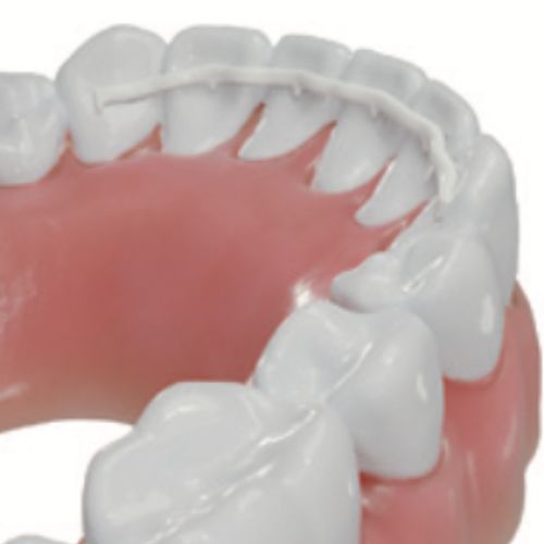 La contention sur-mesure en PEEK<br>Récessions gingivales mandibulaires : rôle de la position dentaire et impact potentiel de la contention